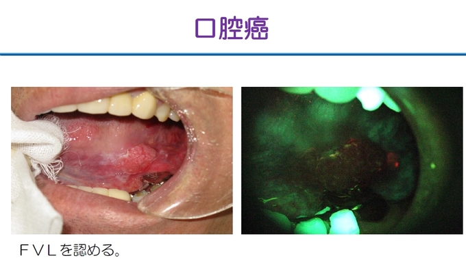 VELscope 口腔がん.jpg